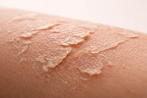 خشکی پوست در زمستان